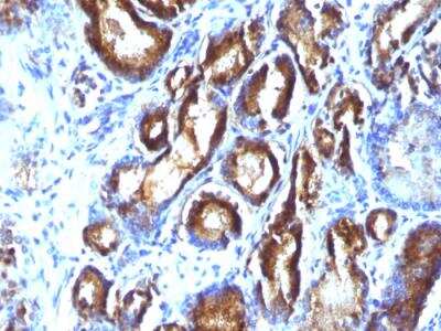 Immunohistochemistry-Paraffin: Kallikrein 3/PSA Antibody (KLK3/801 + KLK3/1248) - IHC-Prediluted [NBP2-48353] - Formalin-fixed, paraffin-embedded human Prostate Carcinoma stained with PSA Monoclonal Antibody (KLK3/801 + KLK3/1248).