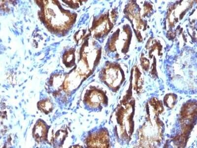 Immunohistochemistry-Paraffin: Kallikrein 3/PSA Antibody (KLK3/801 + KLK3/1248) [NBP2-44890] - Human Prostate Carcinoma stained with PSA Monoclonal Antibody (KLK3/801 + KLK3/1248).