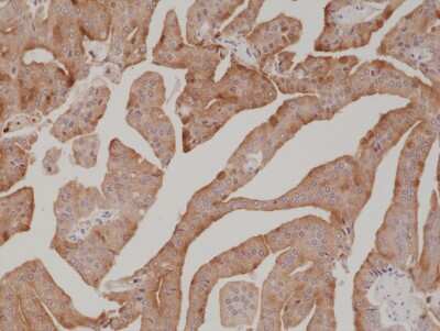 Immunohistochemistry: Kallikrein 3/PSA Antibody (RM323) [NBP2-77416] - Immunohistochemical staining of formalin fixed and paraffin embedded human prostate cancer tissue section using NBP2-77416.