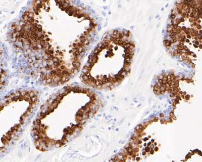 Immunohistochemistry-Paraffin: Kallikrein 3/PSA Antibody (SD07-45) [NBP2-67746] - Immunohistochemical analysis of paraffin-embedded human prostate cancer tissue using anti-Kallikrein 3/PSA antibody. The section was pre-treated using heat mediated antigen retrieval with Tris-EDTA buffer (pH 8.0-8.4) for 20 minutes. The tissues were blocked in 5% BSA for 30 minutes at room temperature, washed with ddH2O and PBS, and then probed with the primary antibody (1/200) for 30 minutes at room temperature. The detection was performed using an HRP conjugated compact polymer system. DAB was used as the chromogen. Tissues were counterstained with hematoxylin and mounted with DPX.