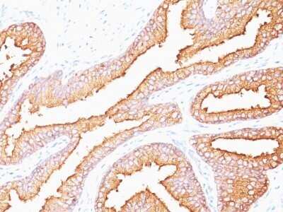 Immunohistochemistry-Paraffin: Kallikrein 3/PSA Antibody (SPM352) - IHC-Prediluted [NBP2-44885] - Formalin-fixed, paraffin-embedded human Prostate Carcinoma stained with Kallikrein 3/PSA Antibody (SPM352).