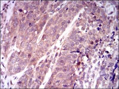 Immunohistochemistry-Paraffin: Keap1 Antibody (7G4B10) [NBP2-37431] - Analysis of  bladder cancer tissues using KEAP1 mouse mAb with DAB staining.