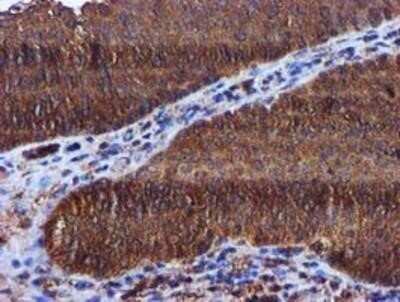 Immunohistochemistry: Keap1 Antibody (OTI1B4) - Azide and BSA Free [NBP2-71496] - Staining of paraffin-embedded Carcinoma of Human bladder tissue using anti-KEAP1 mouse monoclonal antibody.