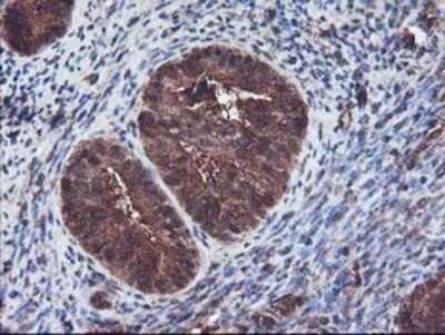 Immunohistochemistry-Paraffin: Keap1 Antibody (OTI1B4) [NBP2-03319] - Staining of paraffin-embedded Adenocarcinoma of Human endometrium tissue using anti-KEAP1 mouse monoclonal antibody.