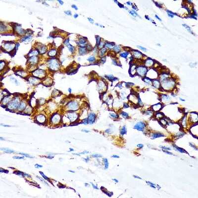 Immunohistochemistry-Paraffin: Keratin 36 Antibody [NBP3-03706] - Immunohistochemistry of paraffin-embedded human lung cancer using Keratin 36 Rabbit pAb (NBP3-03706) at dilution of 1:100 (40x lens). Perform microwave antigen retrieval with 10 mM Tris/EDTA buffer pH 9.0 before commencing with IHC staining protocol.