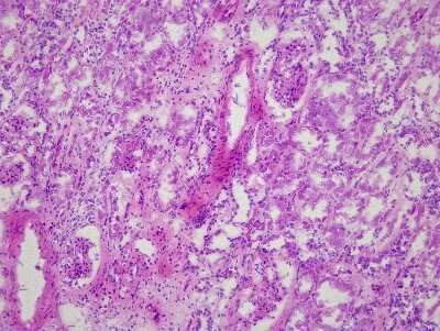 Hematoxylin & Eosin Stain: Kidney Tissue Slides (Diabetes) [NBP2-77728] - Tissue: Human Kidney,  Pathology: Diabetes Type II