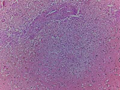 Hematoxylin & Eosin Stain: Kidney Tissue Slides (Wilms' Tumor) [NBP2-77907] - Tissue: Human Kidney,  Pathology: Wilms' Tumor