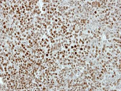 Immunohistochemistry-Paraffin: Kif4A Antibody [NBP2-17056] - TOV-112D xenograft, using KIF4A antibody at 1:500 dilution. Antigen Retrieval: Trilogy™ (EDTA based, pH 8.0) buffer, 15min.