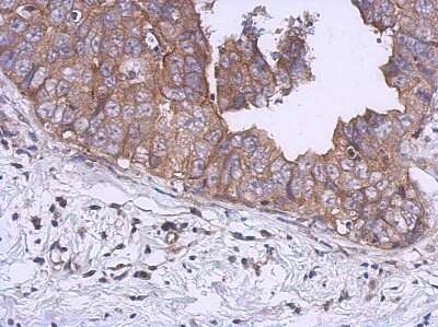 Immunohistochemistry-Paraffin: Kinesin 5B Antibody [NBP1-31022] - Paraffin-embedded Breast ca, using antibody at 1:500 dilution.