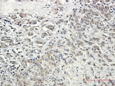 Immunohistochemistry-Paraffin: Kinesin 5B Antibody (S04-6G8) [NBP3-14868] - Immunohistochemistry of Kinesin 5B in paraffin-embedded Human breast cancer tissue using Kinesin 5B Rabbit mAb at dilution 1/50