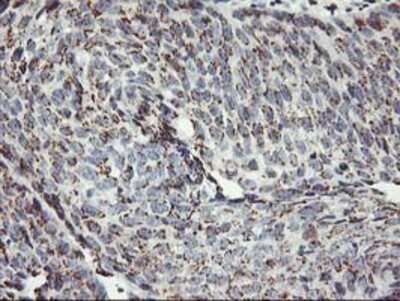 Immunohistochemistry: Kir3.1 Antibody (OTI1G3) - Azide and BSA Free [NBP2-71065] - Staining of paraffin-embedded Carcinoma of Human bladder tissue using anti-Kir3.1 mouse monoclonal antibody.