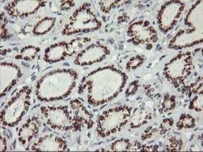 Immunohistochemistry: Kir3.1 Antibody (OTI1G3) - Azide and BSA Free [NBP2-71065] - Staining of paraffin-embedded Carcinoma of Human thyroid tissue using anti-Kir3.1 mouse monoclonal antibody.