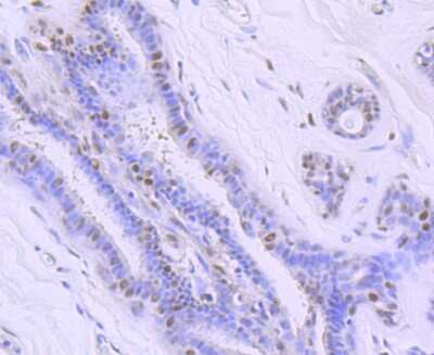Immunohistochemistry-Paraffin: Ku70/XRCC6 Antibody (JM61-31) [NBP2-66920] - Analysis of paraffin-embedded human breast cancer tissue using anti-Ku 70 antibody. Counter stained with hematoxylin.