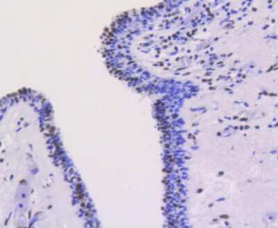 Immunohistochemistry-Paraffin: Ku80/XRCC5 Antibody (SC06-14) [NBP2-67583] - Analysis of paraffin-embedded human breast carcinoma tissue using anti-Ku80 antibody. Counter stained with hematoxylin.