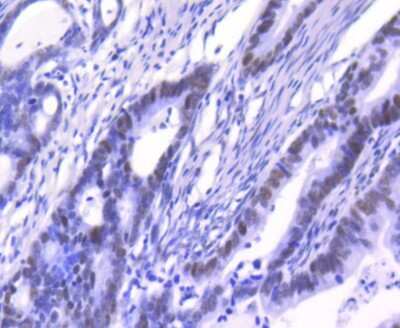 Immunohistochemistry-Paraffin: Ku80/XRCC5 Antibody (SC06-14) [NBP2-67583] - Analysis of paraffin-embedded human colon cancer tissue using anti-Ku80 antibody. Counter stained with hematoxylin.