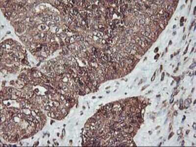 Immunohistochemistry: KvBeta1 Antibody (OTI4E7) - Azide and BSA Free [NBP2-71344] - Staining of paraffin-embedded Adenocarcinoma of Human ovary tissue using anti-KvBeta1.1 mouse monoclonal antibody.