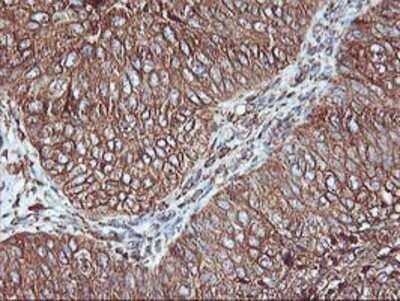 Immunohistochemistry: KvBeta1 Antibody (OTI4E7) - Azide and BSA Free [NBP2-71344] - Staining of paraffin-embedded Carcinoma of Human bladder tissue using anti-KvBeta1.1 mouse monoclonal antibody.