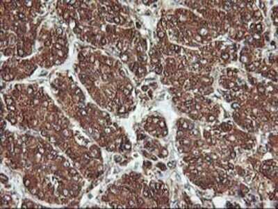 Immunohistochemistry: KvBeta1 Antibody (OTI4E7) - Azide and BSA Free [NBP2-71344] - Staining of paraffin-embedded Carcinoma of Human liver tissue using anti-KvBeta1.1 mouse monoclonal antibody.