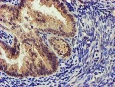 Immunohistochemistry: KvBeta1 Antibody (OTI7F12) - Azide and BSA Free [NBP2-71349] - Analysis of Adenocarcinoma of Human endometrium tissue. (Heat-induced epitope retrieval by 10mM citric buffer, pH6.0, 120C for 3min)