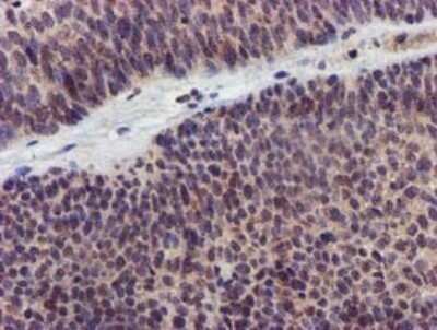 Immunohistochemistry: KvBeta1 Antibody (OTI7F12) - Azide and BSA Free [NBP2-71349] - Analysis of Carcinoma of Human bladder tissue. (Heat-induced epitope retrieval by 10mM citric buffer, pH6.0, 120C for 3min)