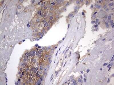 Immunohistochemistry: Kynureninase Antibody (OTI1H1) - Azide and BSA Free [NBP2-71400] - Analysis of Adenocarcinoma of Human breast tissue.