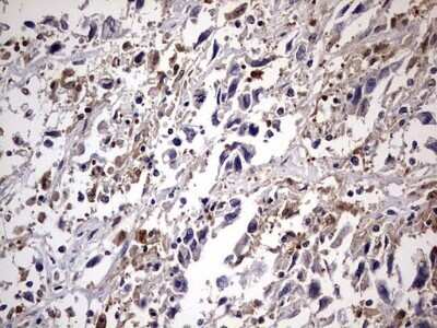 Immunohistochemistry: Kynureninase Antibody (OTI1H1) - Azide and BSA Free [NBP2-71400] - Analysis of Adenocarcinoma of Human ovary tissue.