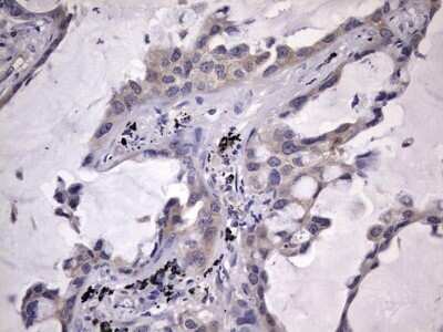 Immunohistochemistry: Kynureninase Antibody (OTI1H1) - Azide and BSA Free [NBP2-71400] - Analysis of Carcinoma of Human lung tissue.