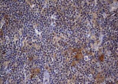 Immunohistochemistry: Kynureninase Antibody (OTI1H1) - Azide and BSA Free [NBP2-71400] - staining of paraffin-embedded Human lymphoma tissue using anti-KYNU mouse monoclonal antibody. ; heat-induced epitope retrieval by 1 mM EDTA in 10mM Tris, pH8.5, 120C for 3min)