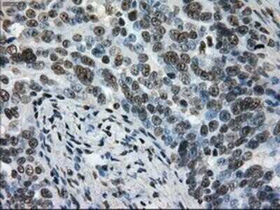 Immunohistochemistry: L1CAM Antibody (OTI2A6) - Azide and BSA Free [NBP2-71097] - Staining of paraffin-embedded Adenocarcinoma of ovary tissue using anti-L1CAM mouse monoclonal antibody.