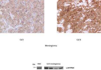 Immunohistochemistry-Paraffin: L3HYPDH Antibody [NBP2-31648] - L3HYPDH at 1:25, using EDTA pre-treatment, on WHO grade I and II meningioma cell lysates on paraffin slides. Relatively weak staining requiring a very high antibody concentration to obtain good quality tissue stains. Image submitted by a verified customer review. 