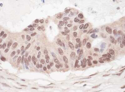 Immunohistochemistry-Paraffin: L3MBTL2 Antibody [NBP1-49965] - Human ovarian carcinoma. Antibody: Affinity purified rabbit anti-L3MBTL2 used at a dilution of 1:1,000 (1ug/ml). Detection: Vector ImmPACT NovaRED