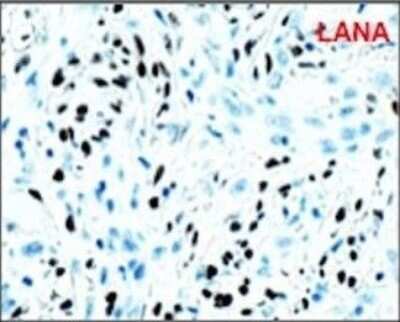 Immunohistochemistry-Paraffin: LANA2 Antibody (CM-A807) [NB200-167] - vIRF3 expression in KS tissues. We obtained KS tissue microarrays from AIDS Cancer Specimen Resource and performed immunohistochemistry, visualized by Aperio F.L. digital pathological scanning. A biopsy sample of KS TMA was stained with anti-LANA. Representative image shows the LANA staining of skin KS lesion. Image collected and cropped by CiteAb from the following publication (//mbio.asm.org/lookup/doi/10.1128/mBio.02217-17), licensed under a CC-BY license.