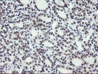 Immunohistochemistry-Paraffin: LANCL2 Antibody (2A11) [NBP2-03893] Staining of paraffin-embedded Carcinoma of Human thyroid tissue using anti-LANCL2 mouse monoclonal antibody.