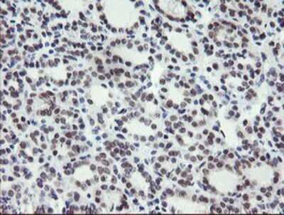 Immunohistochemistry: LANCL2 Antibody (OTI2A11) - Azide and BSA Free [NBP2-72053] - Staining of paraffin-embedded Carcinoma of Human thyroid tissue using anti-LANCL2 mouse monoclonal antibody.