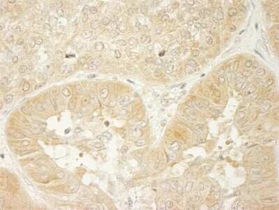 <b>Independent Antibodies Validation. </b>Immunohistochemistry-Paraffin: LARP1 Antibody [NBP1-19129] - Sample: FFPE section of human ovarian carcinoma. Antibody: Affinity purified rabbit anti-LARP1 used at a dilution of 1:200 (1ug/ml). Detection: DAB