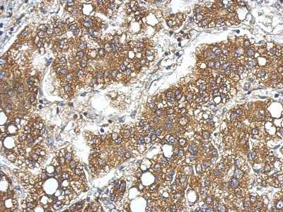 Immunohistochemistry-Paraffin: LCN15 Antibody [NBP2-15017] - Paraffin-embedded Hepatoma, using antibody at 1:500 dilution.