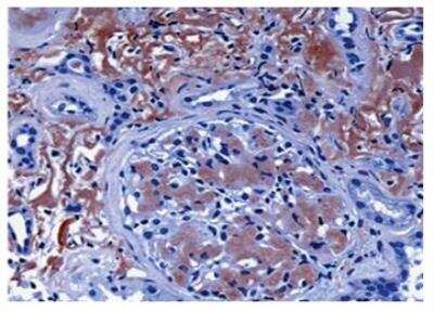 Immunohistochemistry: LECT2 Antibody (MM0449-4B24) [NBP2-11768] - Gomerular and interstitial amyloid deposits show reactivity with anti-LECT2 antibody.