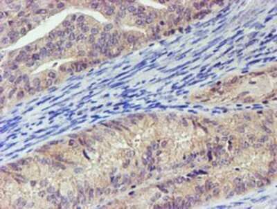 Immunohistochemistry: LECT2 Antibody (OTI2A11) - Azide and BSA Free [NBP2-71122] - Staining of paraffin-embedded Adenocarcinoma of Human endometrium tissue using anti-LECT2 mouse monoclonal antibody.