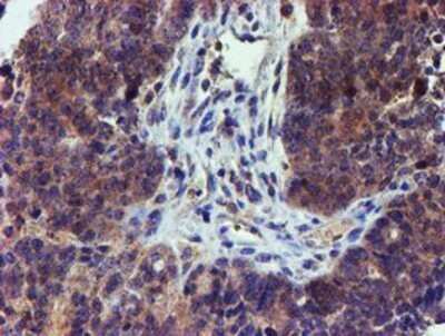 Immunohistochemistry: LECT2 Antibody (OTI2A11) - Azide and BSA Free [NBP2-71122] - Staining of paraffin-embedded Adenocarcinoma of Human ovary tissue using anti-LECT2 mouse monoclonal antibody.