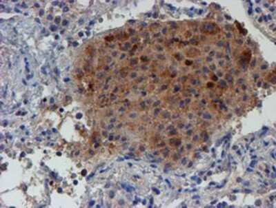 Immunohistochemistry: LECT2 Antibody (OTI2A11) - Azide and BSA Free [NBP2-71122] - Staining of paraffin-embedded Carcinoma of Human lung tissue using anti-LECT2 mouse monoclonal antibody.