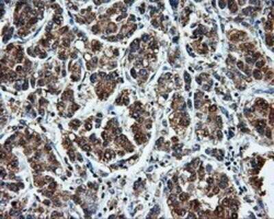 Immunohistochemistry: LEMD3 Antibody (OTI6C10) - Azide and BSA Free [NBP2-71744] - Staining of paraffin-embedded Carcinoma of liver tissue using anti-LEMD3mouse monoclonal antibody.