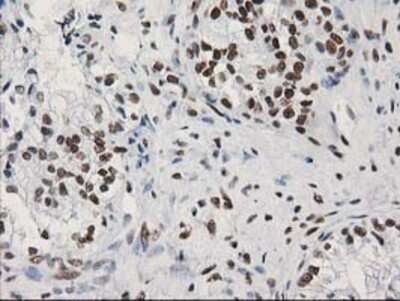 Immunohistochemistry: LENG1 Antibody (OTI10A7) - Azide and BSA Free [NBP2-72202] - Staining of paraffin-embedded Adenocarcinoma of Human ovary tissue using anti-LENG1 mouse monoclonal antibody.