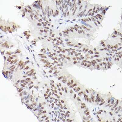 Immunohistochemistry-Paraffin: LEO1 Antibody [NBP3-16704] - Immunohistochemistry of paraffin-embedded human colon carcinoma using LEO1 Rabbit pAb (NBP3-16704) at dilution of 1:100 (40x lens).Perform high pressure antigen retrieval with 10 mM citrate buffer pH 6.0 before commencing with IHC staining protocol.