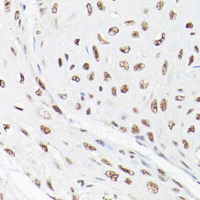 Immunohistochemistry-Paraffin: LEO1 Antibody [NBP3-16704] - Immunohistochemistry of paraffin-embedded human esophageal cancer using LEO1 Rabbit pAb (NBP3-16704) at dilution of 1:100 (40x lens).Perform high pressure antigen retrieval with 10 mM citrate buffer pH 6.0 before commencing with IHC staining protocol.