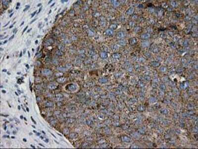 Immunohistochemistry-Paraffin: LGALS3BP Antibody (6B7) [NBP2-01160] - Staining of paraffin-embedded Carcinoma of Human bladder tissue using anti-LGALS3BP mouse monoclonal antibody.