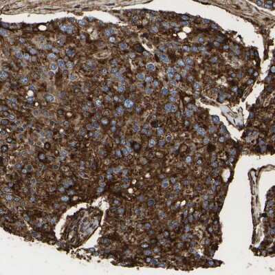 Immunohistochemistry-Paraffin: LIF Antibody [NBP1-85717] - Staining of human prostate cancer shows moderate cytoplasmic positivity.