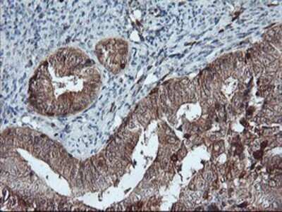 Immunohistochemistry: LIM Kinase 1 Antibody (OTI3H6) - Azide and BSA Free [NBP2-71141] - Staining of paraffin-embedded Adenocarcinoma of Human endometrium tissue using anti-LIM Kinase 1 mouse monoclonal antibody.