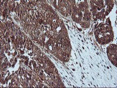 Immunohistochemistry: LIM Kinase 1 Antibody (OTI3H6) - Azide and BSA Free [NBP2-71141] - Staining of paraffin-embedded Adenocarcinoma of Human ovary tissue using anti-LIM Kinase 1 mouse monoclonal antibody.