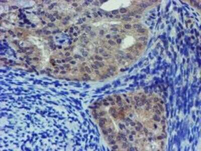 Immunohistochemistry: LIM1 Antibody (OTI2D5) - Azide and BSA Free [NBP2-71134] - Staining of paraffin-embedded Adenocarcinoma of Human endometrium tissue using anti-LIM1 mouse monoclonal antibody.