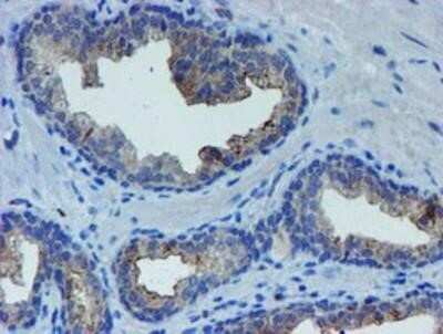 Immunohistochemistry: LIM1 Antibody (OTI2D5) - Azide and BSA Free [NBP2-71134] - Staining of paraffin-embedded Carcinoma of Human prostate tissue using anti-LIM1 mouse monoclonal antibody.